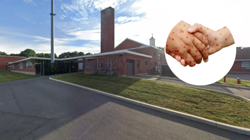 Enfield Measles Outbreak 34 Unvaccinated Kids Affected 2026