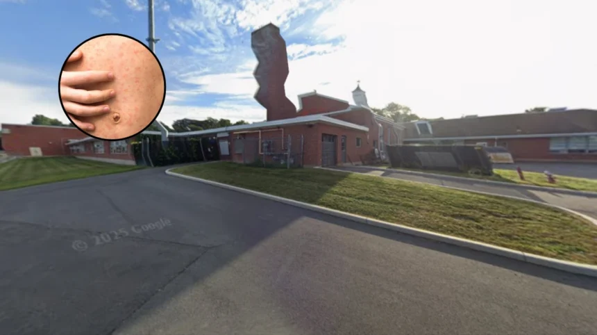 Measles Hits Enfield Schools, Low Jab Boroughs North London 2026