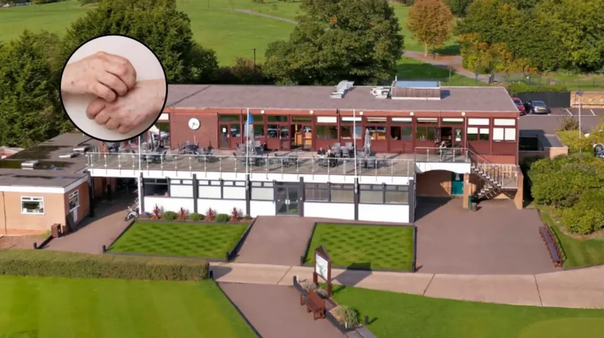 Measles Outbreak Alert in Enfield 2026