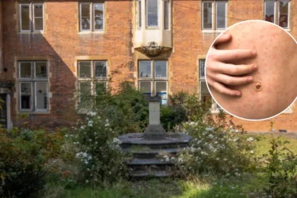 Measles Outbreak Hits Enfield Schools, 60+ Children Infected 2026