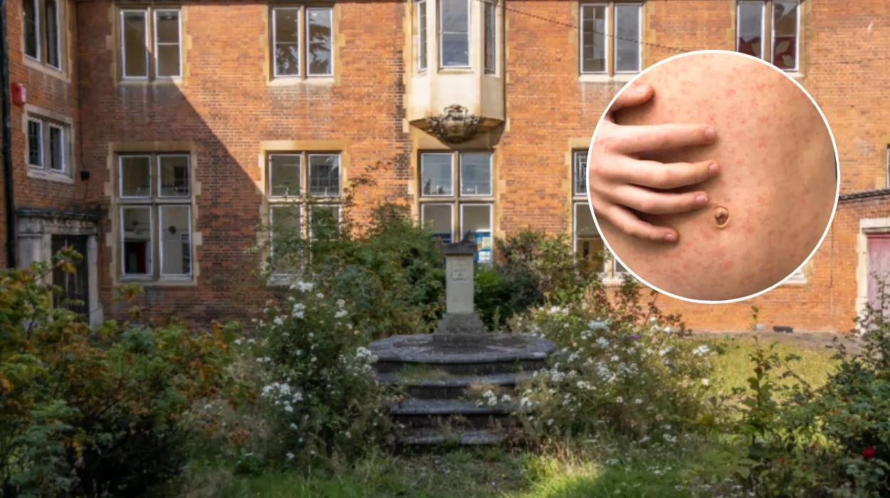 Measles Outbreak Hits Enfield Schools, 60+ Children Infected 2026