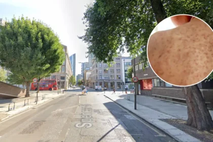 North London Measles Outbreak: GPs Warn of Worse Crisis 2026