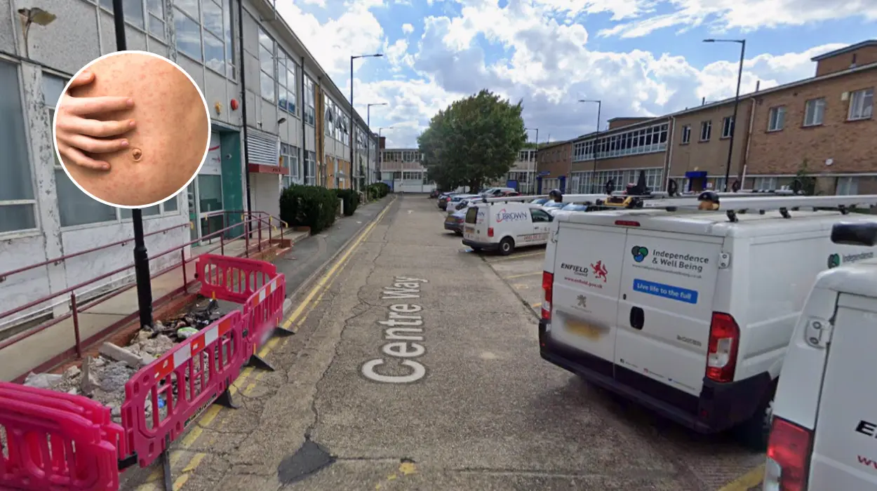 Enfield Tops London's Measles Cases with Low Vaccination Rates 2026